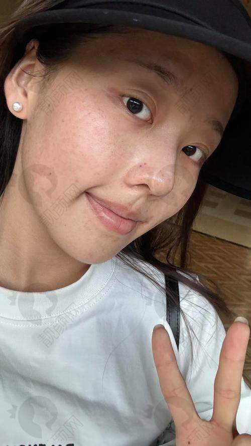 深圳美莱黄金超光子项目优势