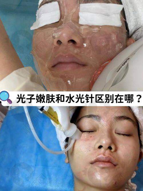 深圳美莱杨鹏医生做黄金超光子价格888元起，知名连锁医美，效果安全有保障 