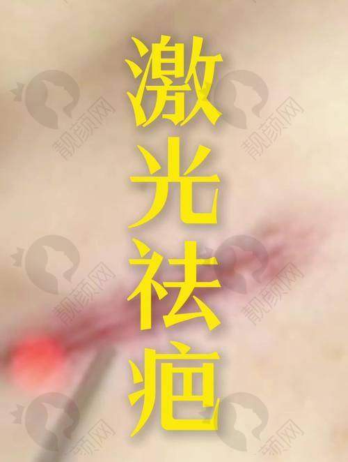 武汉正璞激光祛疤项目优势