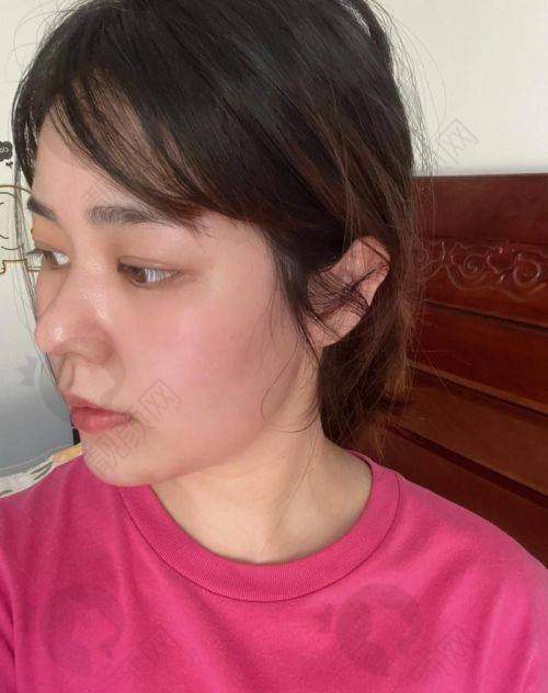 深圳张辉做鼻子，赶紧预约！
