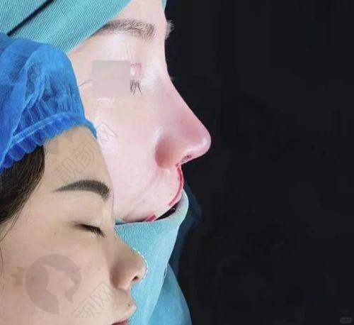 深圳张辉做鼻子怎么样？技术实力揭秘