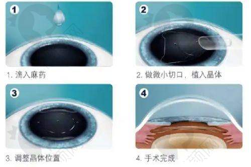 云南大学附属医院眼科近视手术价格表:全飞秒1.5万+,透明价格不坑人