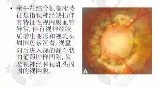 兰州普瑞眼科医院超声乳化白内障价格之价格优势