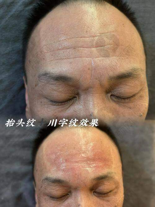 深圳富华整形注射去抬头纹预约方式