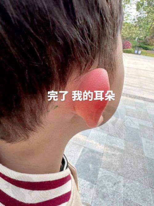 武汉正璞招风耳修复项目优势