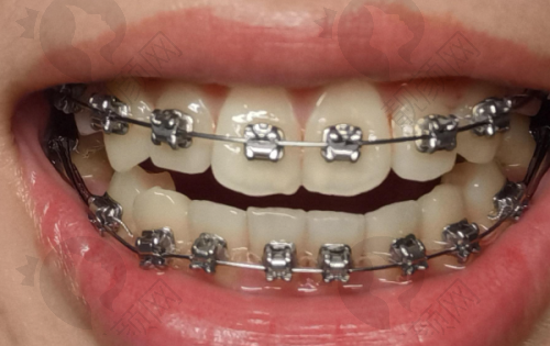 奉送上海曙康种植牙实例对比