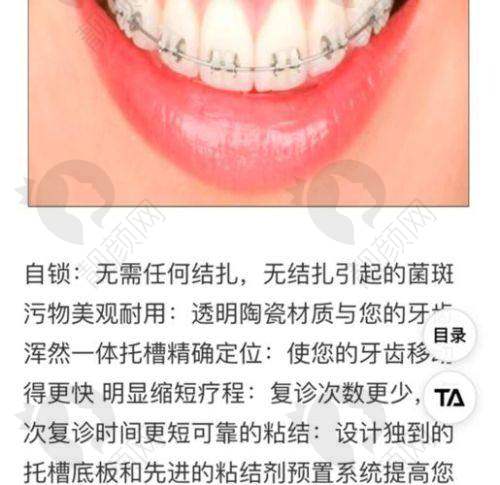 一千元全瓷牙的使用寿命靠谱吗？长寿命为口腔健康保驾护航