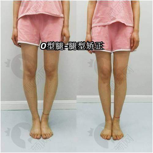 西安西美医院直腿术：技术怎么样？