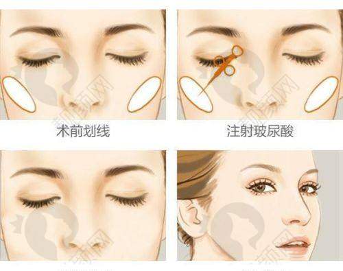 长沙研颜整形：眼部整形的佼佼者