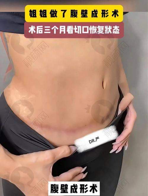 重庆腹壁成型医院哪家好？重庆松山整形医院技术靠谱，口碑良好值得选择