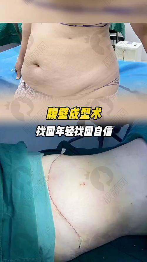 重庆腹壁成型医院哪家好？重庆华美整形外科医院技术靠谱，口碑良好值得选择