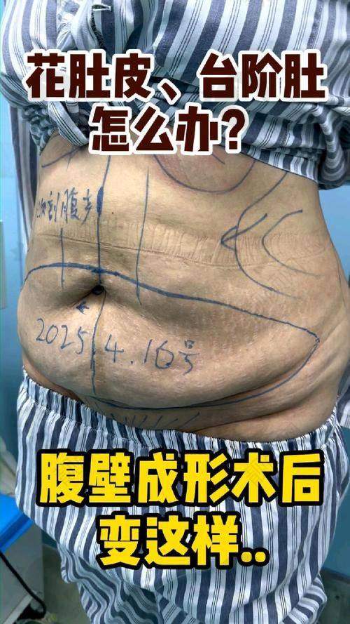 重庆腹壁成型医院哪家好？重庆星荣整形外科医院技术靠谱，口碑良好值得选择