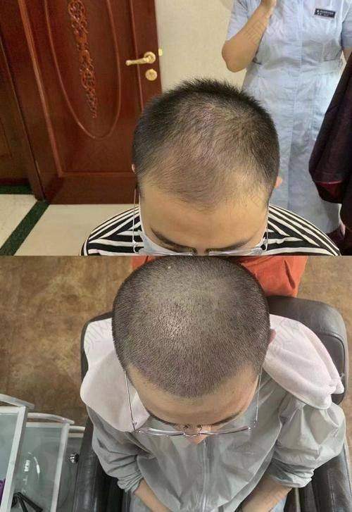 四、珠海九龙医院植发科怎么预约：