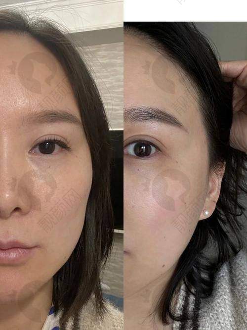 填充太阳穴的过程