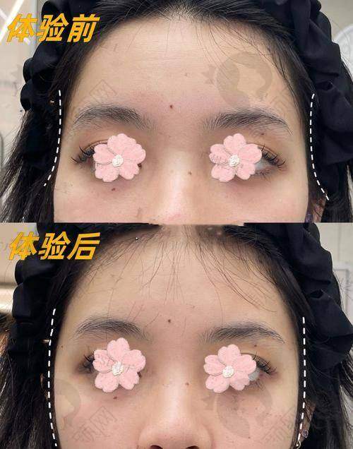 填充后的成效和护理