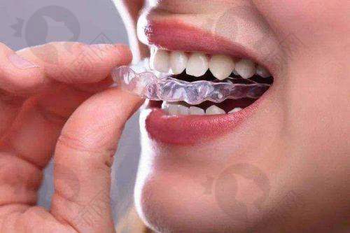上海永华口腔MRC矫治器的具体优势