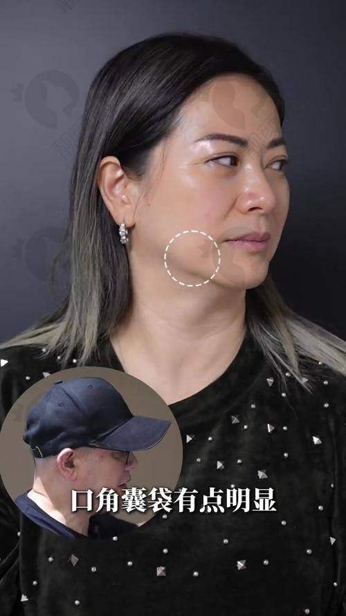 郑州悦容整形医院拉皮手术的具体优势