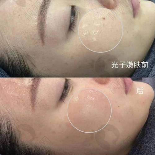 北京氢颜整形水杨酸焕肤价格详情解析