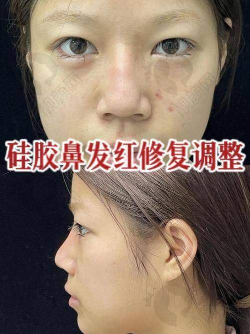 菲林普利隆鼻：独特成分带来持久成效