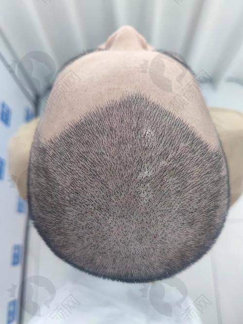 南京新生医院植发怎么样？贴心服务与后续保护