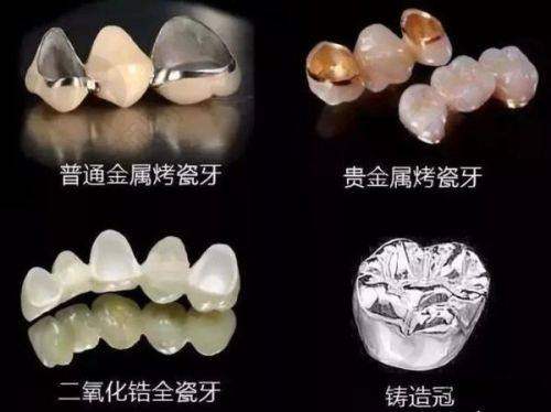 南昌摩尔口腔医院爱尔创全瓷牙牙冠适用症状全知道