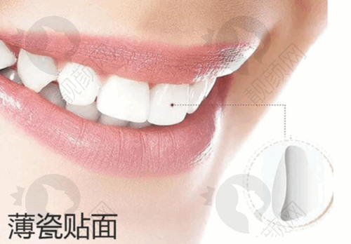 南宁诺贝尔口腔：老牌口腔，牙贴面技术靠谱