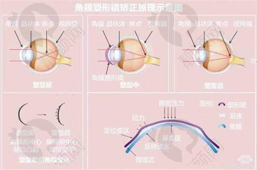 郑州视光眼科医院做近视手术怎么样？多样术式，满足需求