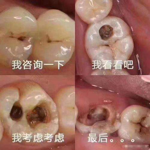 精细揭秘：3 - 6岁儿童龋齿治疗意义大公开