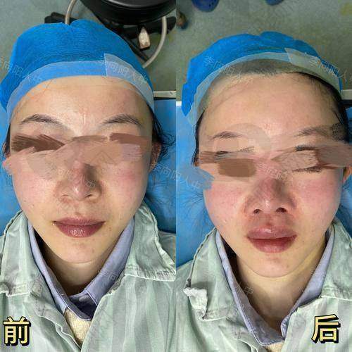 王皓民医生做擅长的人中缩短术怎么样？