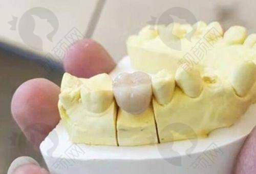 瑞士ITI种植牙按材料分类有哪些型号及优势?