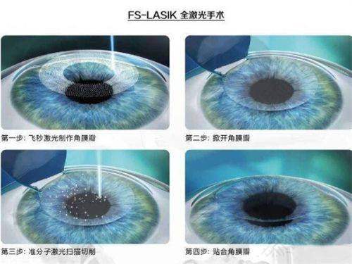 全飞秒4.0与3.0成效差异大揭秘：根据自身情况选，都能告别近视烦恼