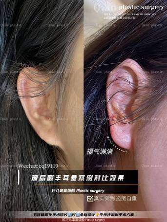 杭州浮想国医疗稚龄耳价格详情解析