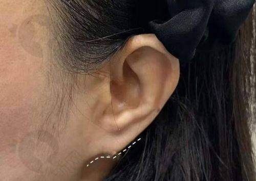 杭州浮想国医疗稚龄耳项目真实评价