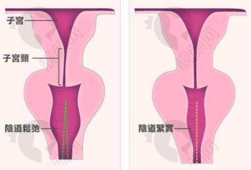 美国viveve缩阴的综合评价与建议