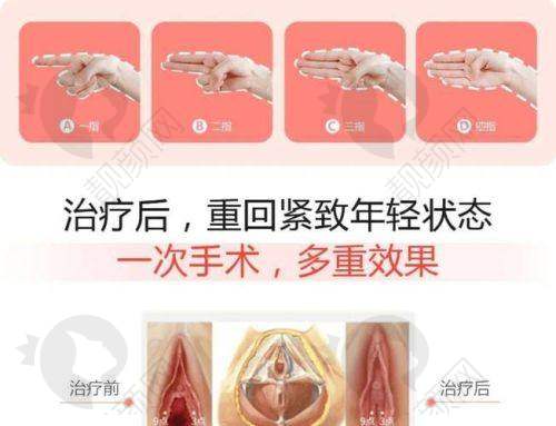 美国viveve缩阴的技术优势