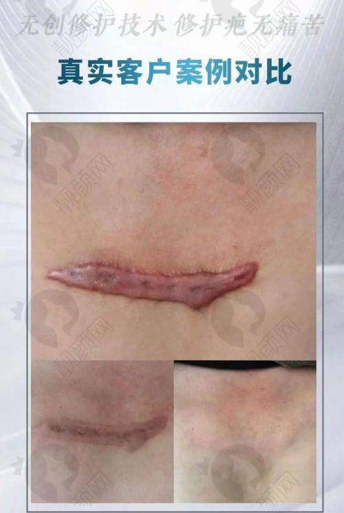 南通美伦医疗美容门诊部：成熟机构，点阵激光淡化疤痕
