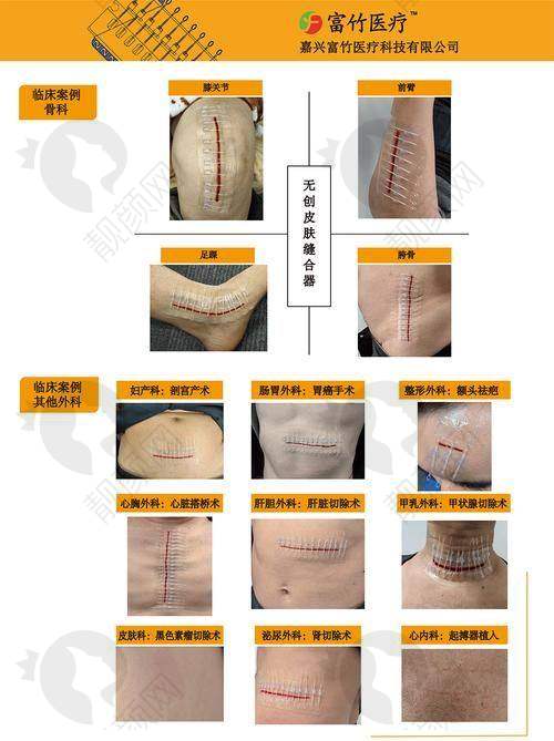 南通大学附属医院：综合实力强，多科室协同祛疤