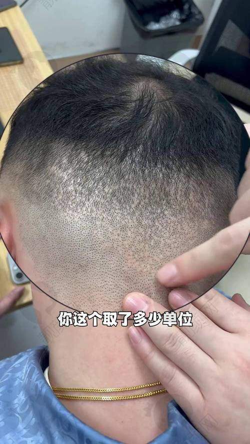 三、福州大麦植发医院医生介绍: