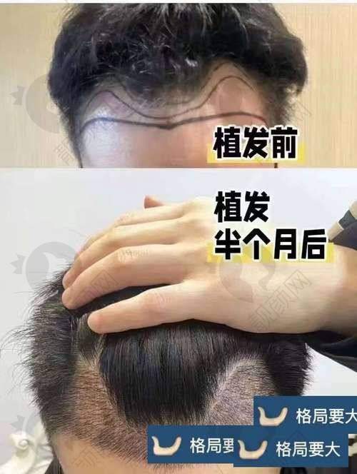六、南京新生植发价格表：（仅供参考）