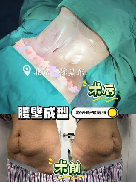 北京画美医疗美容医院：聚焦腹部，专精设计