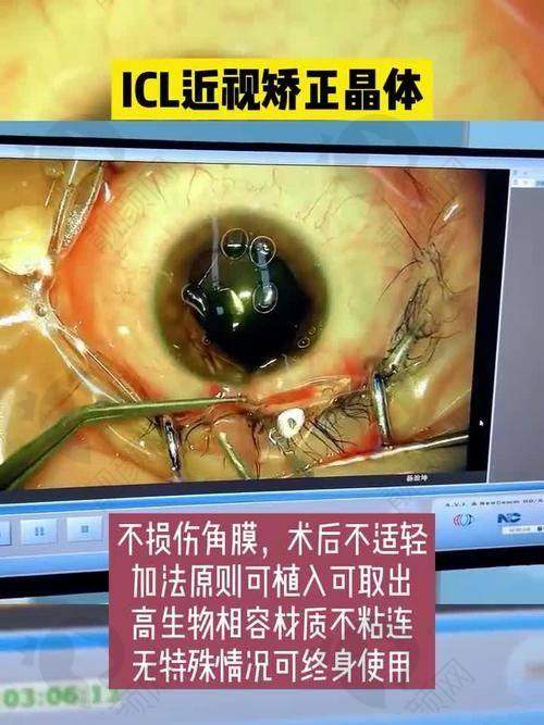海口国爱近视治疗中 心人工虹膜晶体植入的技术特点