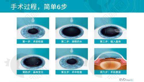 海口国爱近视治疗中 心人工虹膜晶体植入的成功实例