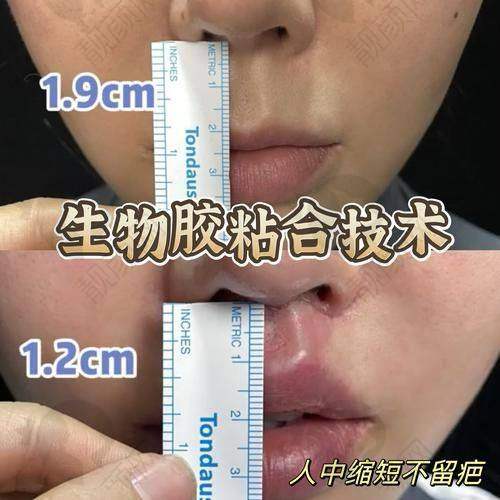 上海丽质整形医院卢九宁医生的真实的患者评价如下：