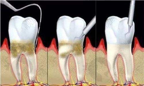 佛山春芽口腔种植牙:口碑超棒