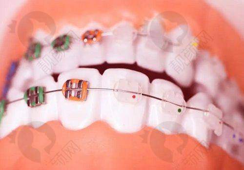 佛山春芽口腔种植牙:价格与服务优势