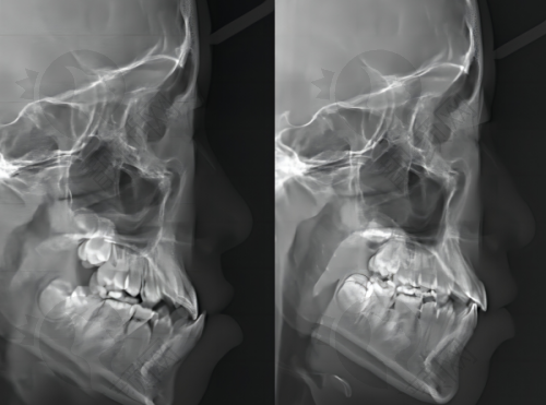 佛山春芽口腔种植牙:术后成效获市民认可