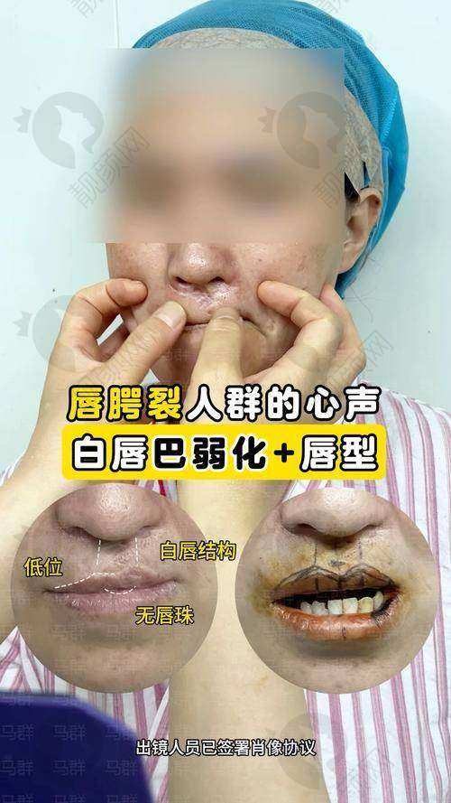 唇腭裂困扰与医院选择