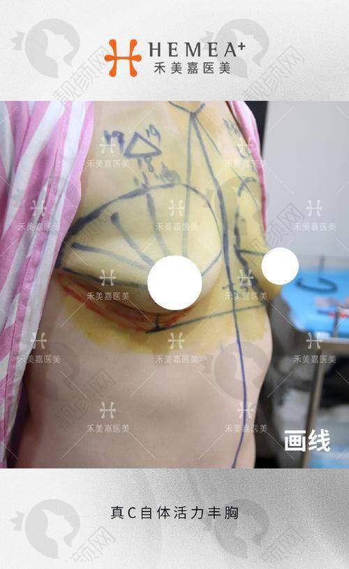 脂肪填充胸成效能维持多久？术后护理是重要保护