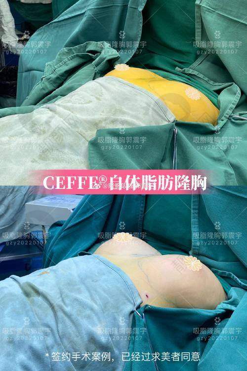 脂肪填充胸成效能维持多久？术后优势之自然美观