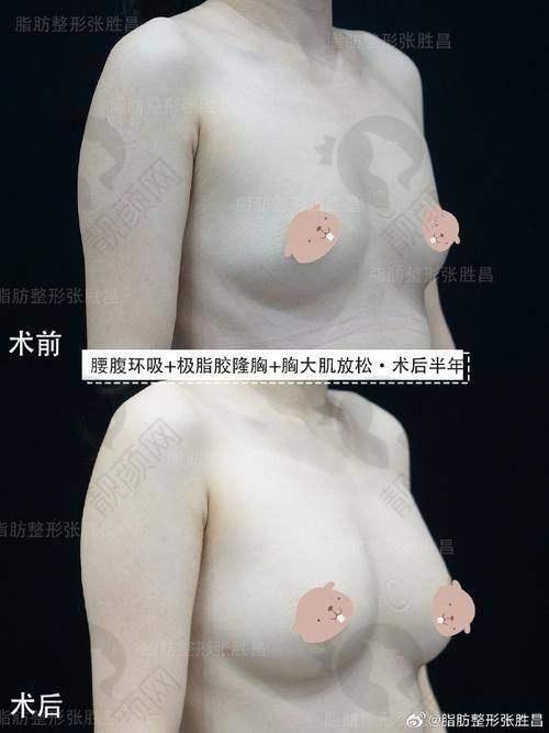 脂肪填充胸成效能维持多久？术后优势之低排异更安心
